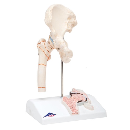 Anatomical Models about Femoral Fracture and Hip Osteoarthritis