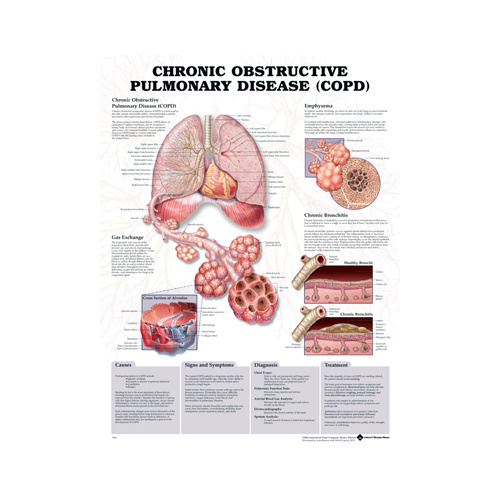 Anatomical Chronic Obstructive Pulmonary Disease Chart