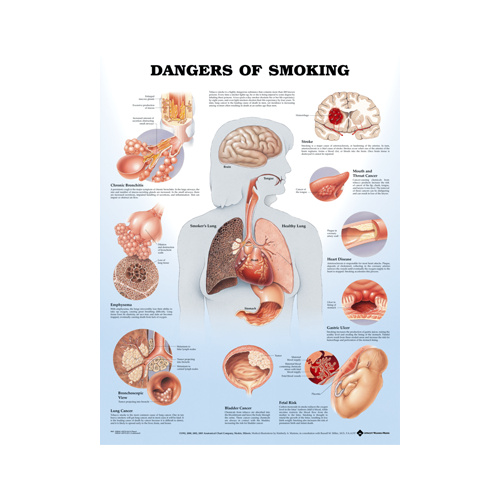 Anatomical Chart- Dangers of Smoking