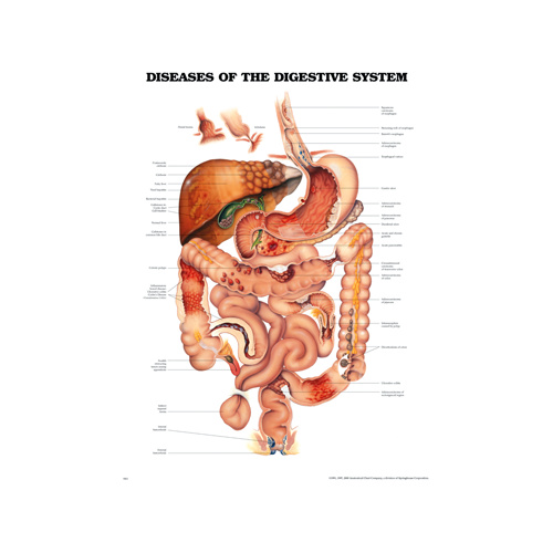 Anatomical Chart- Diseases of the Digestive System 