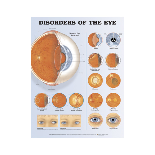 Disorders of the Eye Chart 