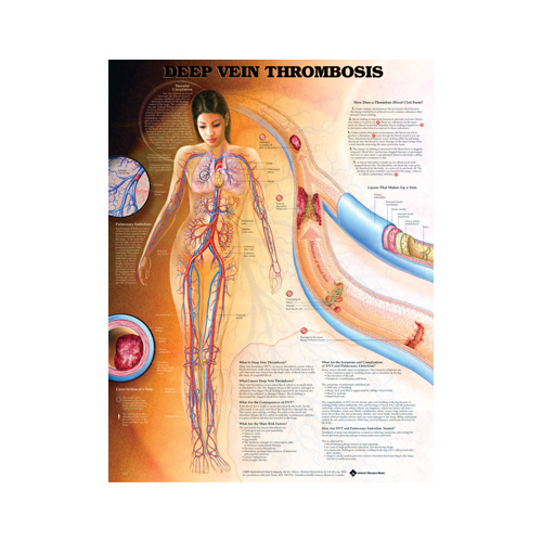 Anatomical Deep Vein Thrombosis Chart