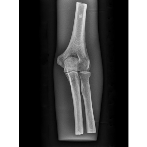 X-Ray Phantom Elbow, Opaque