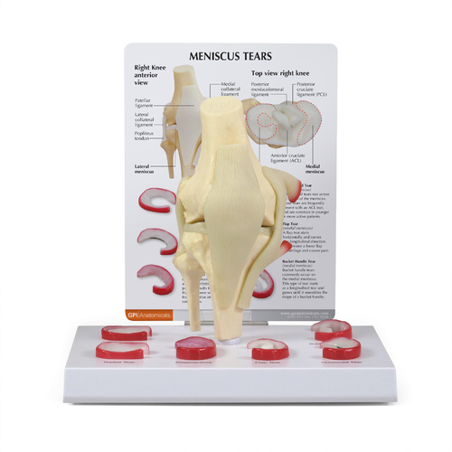 Anatomical Model - Meniscus Tears of the Knee