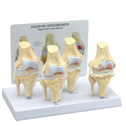Anatomical 4 Stage Osteoarthritis Knee Model