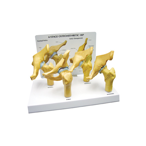 Anatomical 4 Stage Arthritic Hip Model