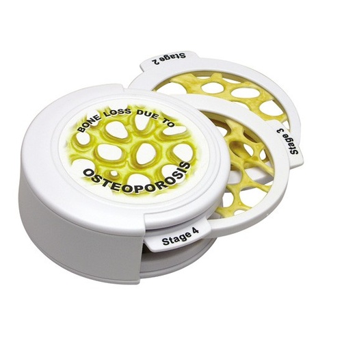Anatomical Model- 4pc Osteoporosis Hinged Disk Set