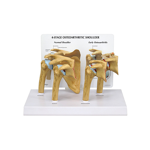 Anatomical 4 Stage Osteoarthritis Shoulder Model