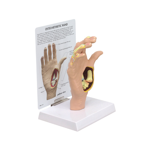 Anatomical Osteoarthritis Hand Model