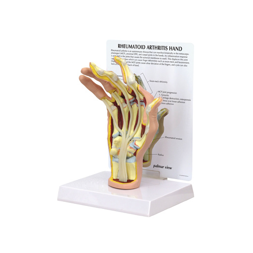 Anatomical Rheumatoid Arthritis Hand Model