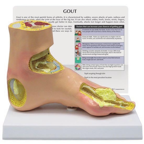 Anatomical Model- Foot Gout 