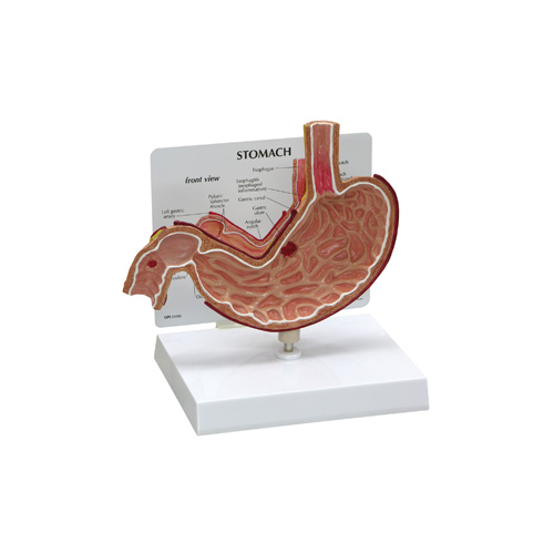Anatomical Stomach with Ulcers Model