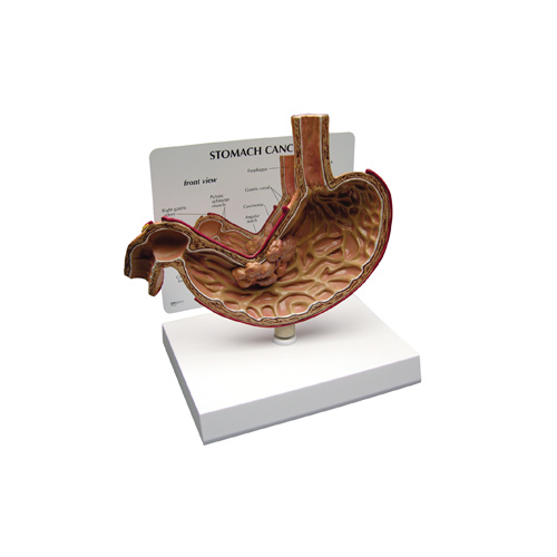 Anatomical Stomach Cancer Model