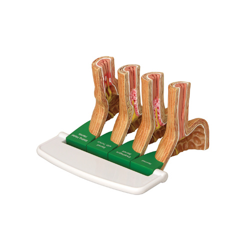 Anatomical Model- Gastroesophageal Reflux Disease (GERD) 