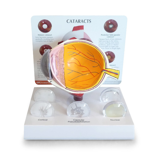 Anatomical Model- Cataract Eye