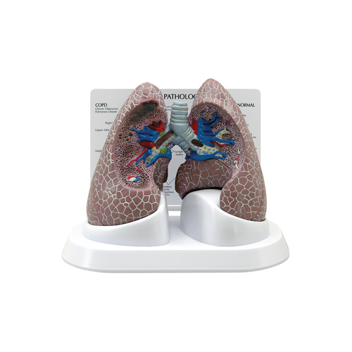 Diseased Lung