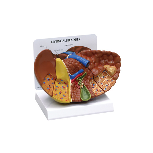 Anatomical Model- Diseased Liver