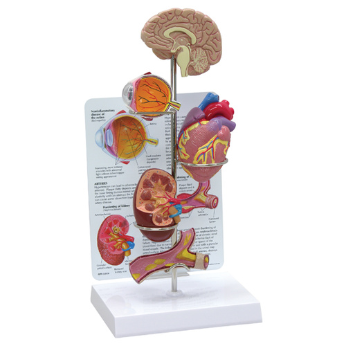 Anatomical Model- Hypertension Model Set