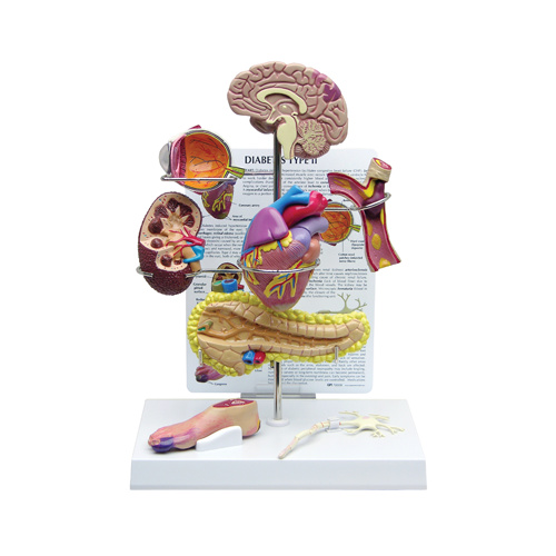 Anatomical Model- Type II Diabetes Set