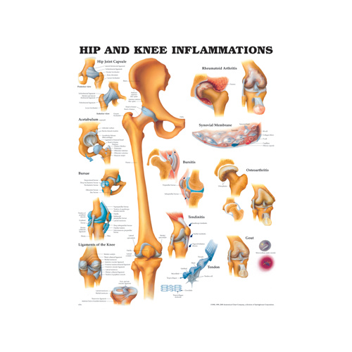 Anatomical Hip and Knee Inflammations Chart
