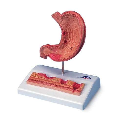 Anatomical Stomach with Ulcers Model