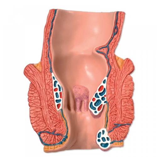 Anatomical Model- Hemorrhoid Model