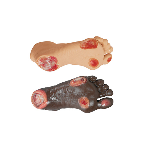 Elderly Pressure Ulcer Foot