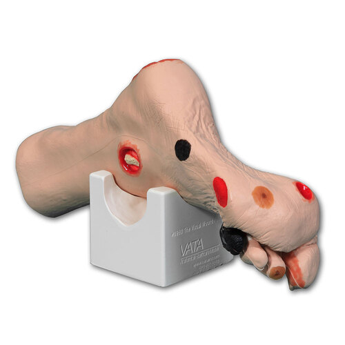 Wilma Wound Foot