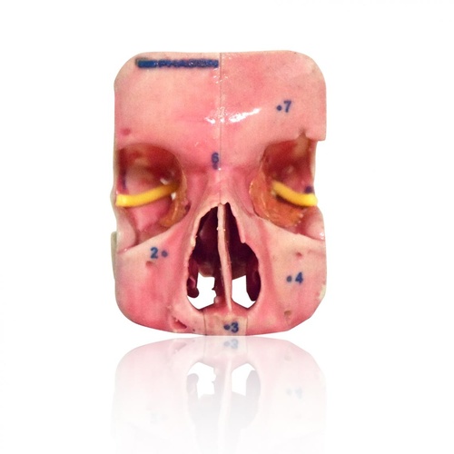 PHACON Sinus Patient “Meyer” – subcranial extension (SN-am)