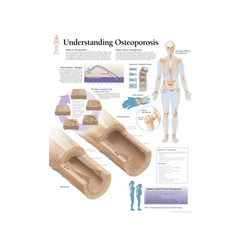 Essay about osteoporosis