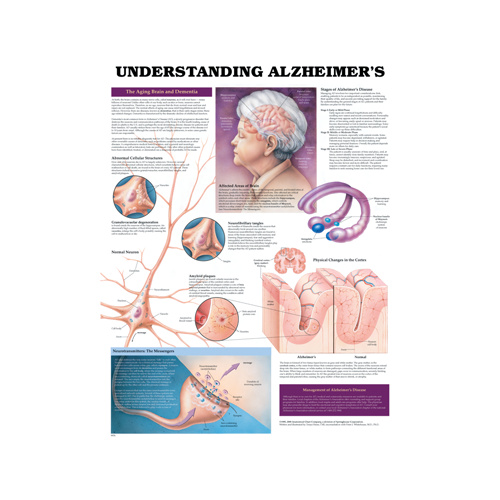 Anatomical Chart- Understanding Alzheimer's