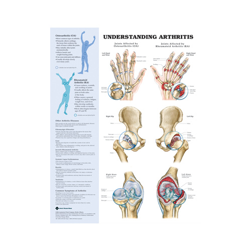 Anatomical Chart- Understanding Arthritis