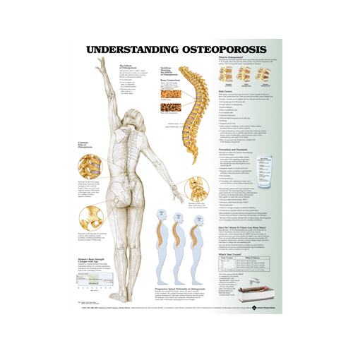 Anatomical Chart- Understanding Osteoporosis Chart