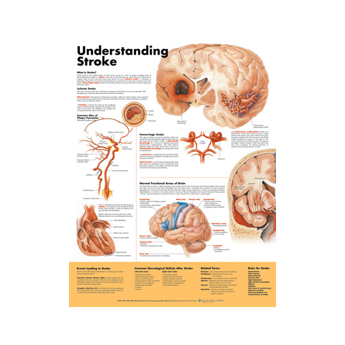 Understanding Stroke Chart