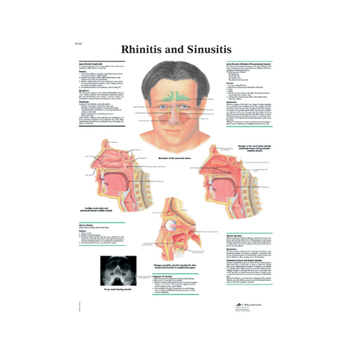 Anatomical Rhinitis and Sinusitis Chart